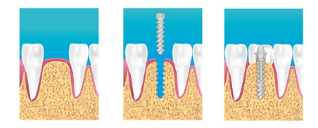 Implants dentaires Marseille 13005
