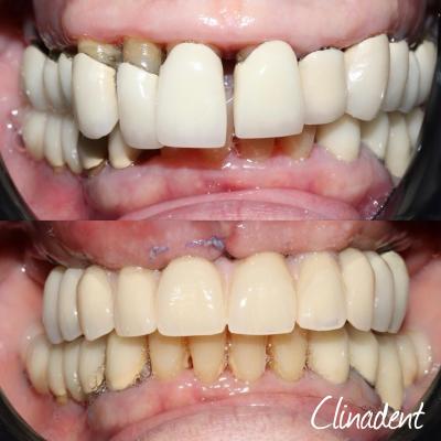 6 implants centre dentaire clinadent marseille sakakini 13005