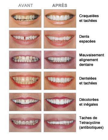 Dyschromies dentaires Marseille 13005