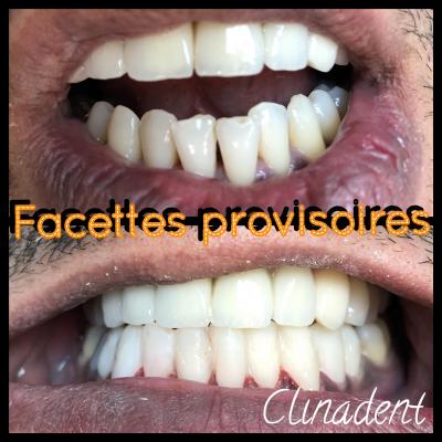 Facettes dentaires au Centre Clinadent à Marseille Sakakini